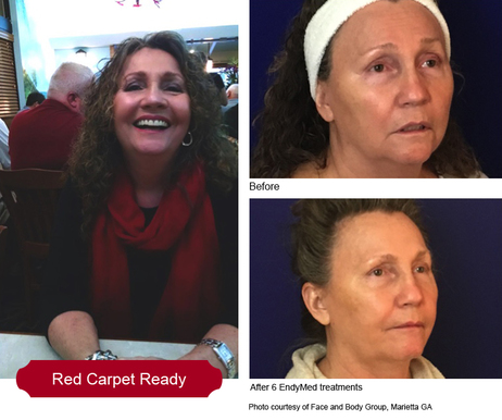 EndyMed RF Micro Needling Before and After Photo